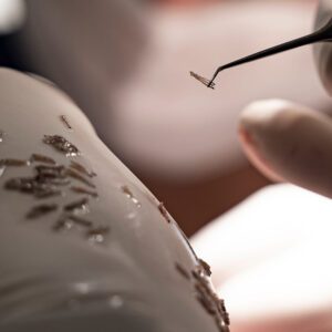 Haartransplantation FUE